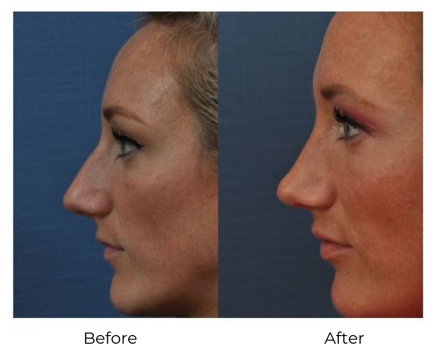 rhinoplasty expert nyc